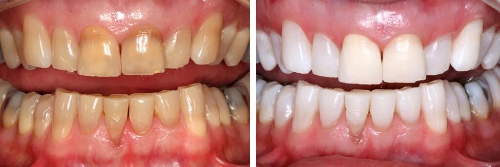 Why Might Someone Choose Kor Teeth Whitening Over Other Available Teeth Whitening Options?