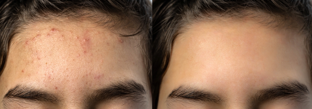 Facing the Facts: What’s Really Behind Your Forehead Acne Woes?