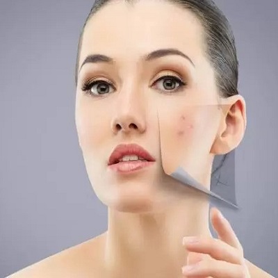 Conquering Acne Scars: Effective Treatments for Clearer Skin