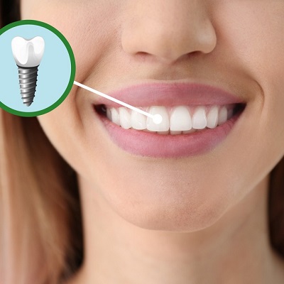 Transforming Smiles: The Comprehensive Guide to Dental Implant Treatment